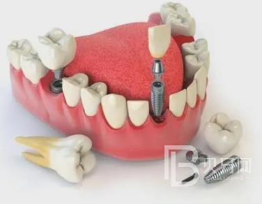 廣州好佰年口腔怎么樣？廣州好佰年口腔口碑好不好？廣州好佰年口腔種植牙價(jià)格