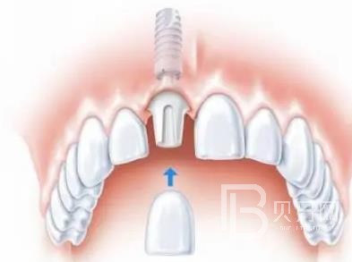 廣州全家?？谇辉趺礃樱繌V州全家?？谇环N植牙一顆多少錢