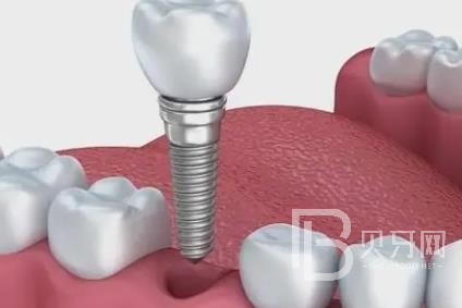 廣州愛威白口腔怎么樣？廣州愛威白口腔口碑好不好？廣州愛威白口腔種植牙價格