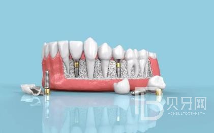 廣州六月微笑口腔怎么樣？廣州六月微笑口腔口碑好不好？廣州六月微笑口腔種植牙價格