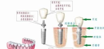 70歲的老人骨量不足還能做種植牙嗎？北京海德堡口腔怎么樣？