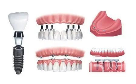 半口種植牙需要幾個(gè)種植體？北京牙管家口腔怎么樣？