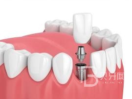 老年人適合種植牙么？北京薇琳口腔種植牙怎么樣？