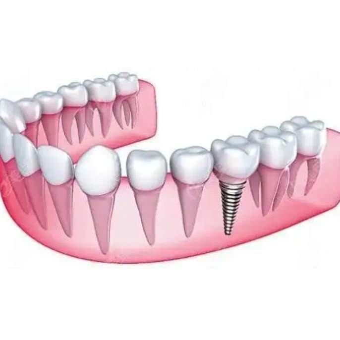 杭州種植一顆假牙多少錢！杭州聞喜淇杰口腔醫(yī)院(余杭古墩路口腔診所)種植牙價(jià)格表?yè)屜瓤?，?guó)產(chǎn)拜阿蒙種植牙：2371元起/顆！