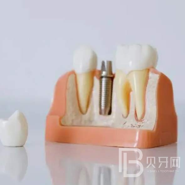 杭州種植一顆假牙多少錢！桐廬付現(xiàn)生口腔診所種植牙醫(yī)院排名TOP1，瑞典諾貝爾種植牙：5417元起/顆！