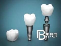 北京種植牙齒價(jià)格多少？含北京種植牙價(jià)格表！