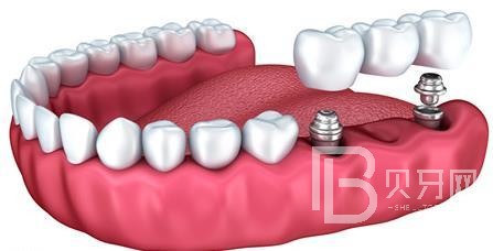 什么是半口種植牙？東莞國貿(mào)口腔來回答