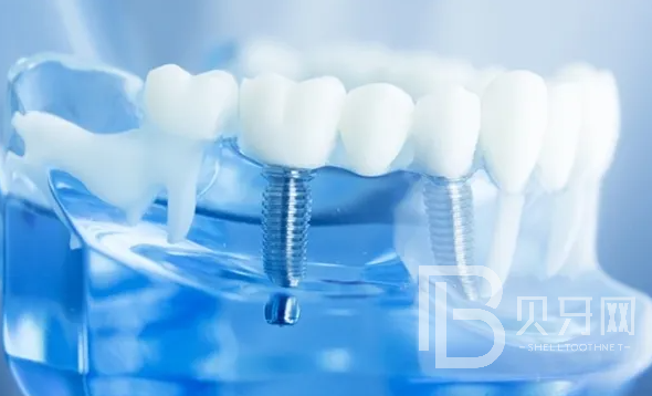 東莞牙博士口腔可以做種植牙嗎？