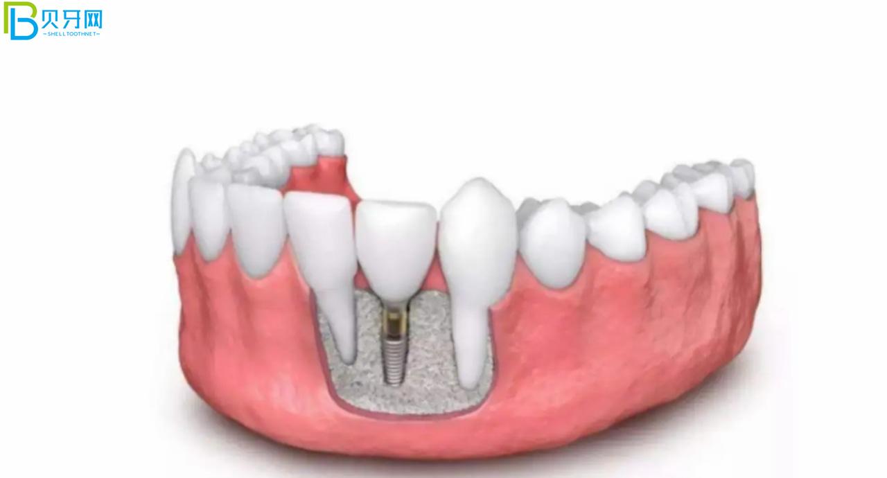 裝假牙怎么能少的了唯美口腔,聽(tīng)說(shuō)鑲牙3500元起?